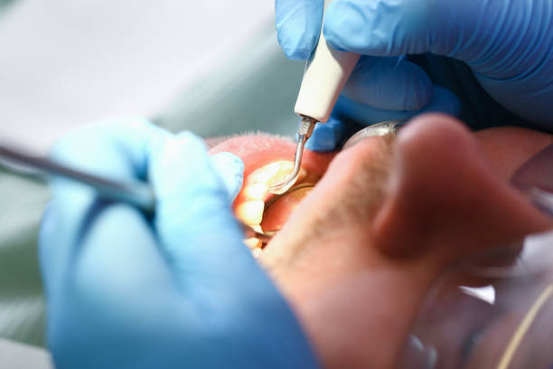 Best Emergency Tooth Extraction in Madison Lake, MN