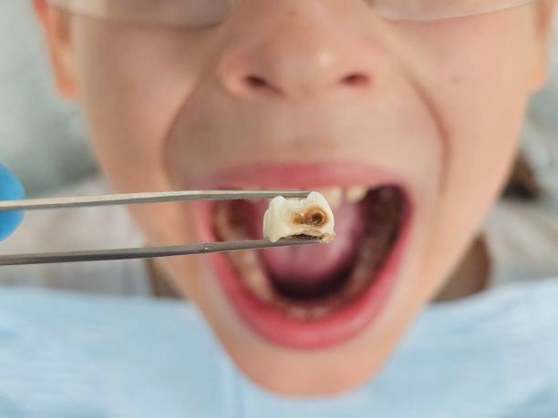 Best Emergency Tooth Extraction in Madison Lake, MN